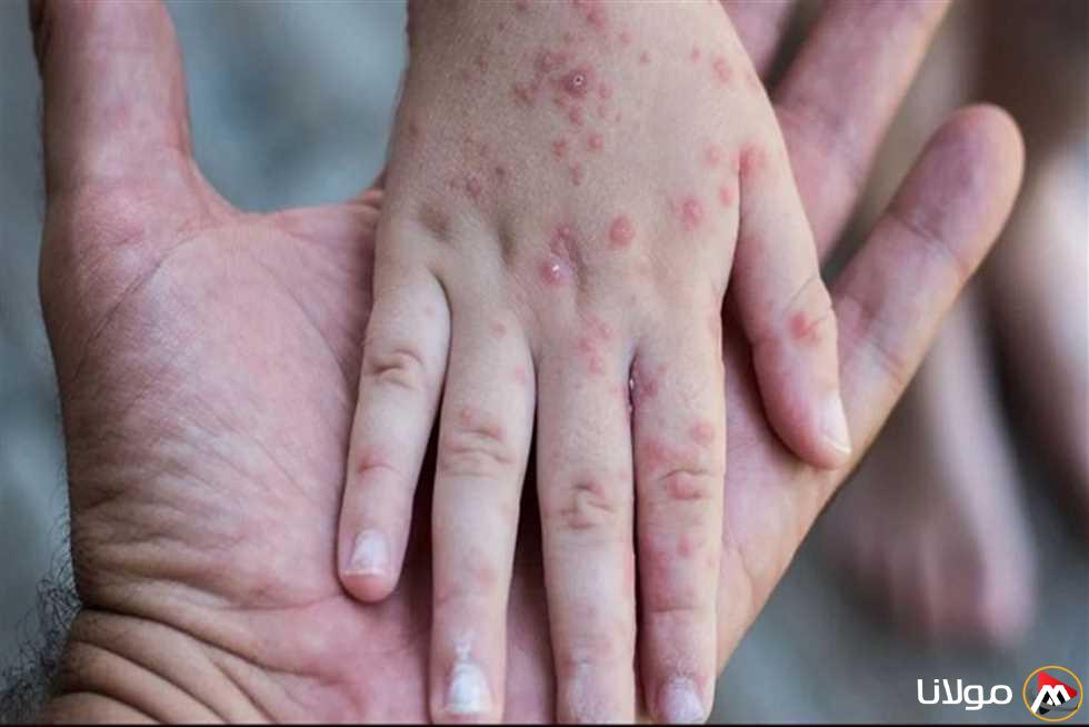يتفشى في المدارس: تعرف على أعراض الجدري المائي، العلاج، ووسائل الوقاية (في 3 خطوات)